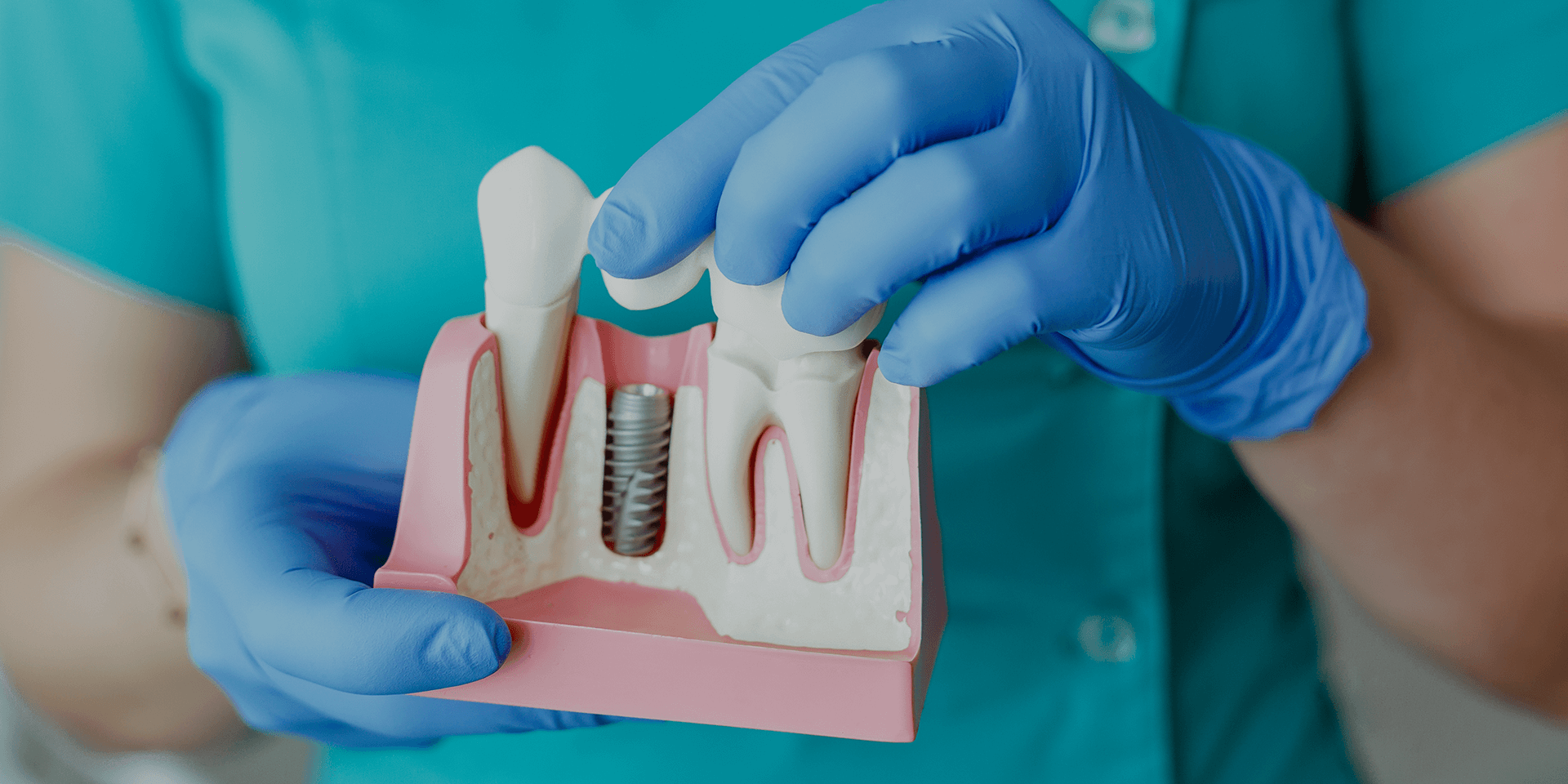 Dentist holding a tooth model with a dental implant.
