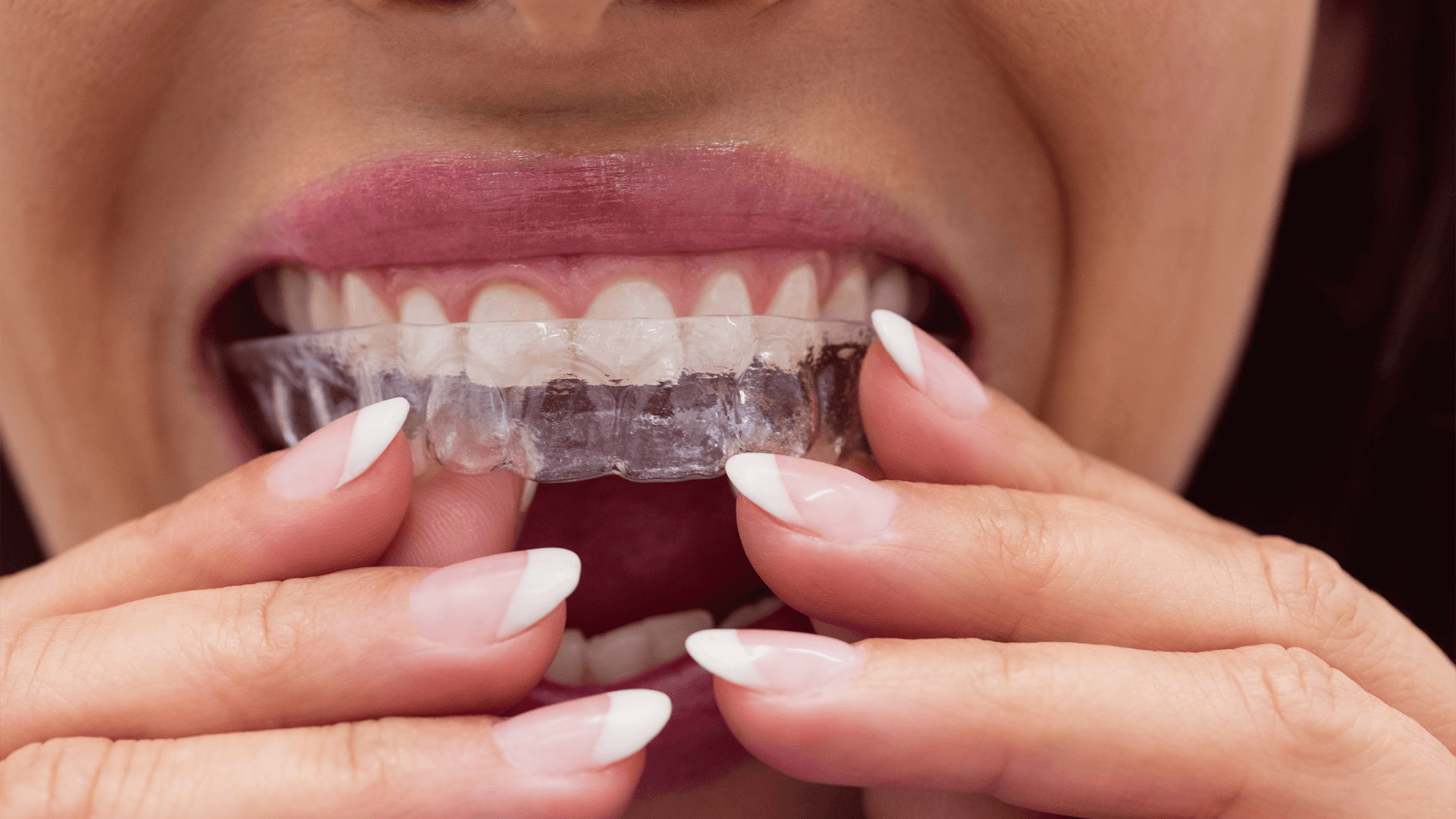 Smile with invisalign.